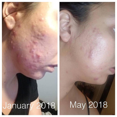 Organic Acne Fighter Oil Serum – Clear Skin Treatment