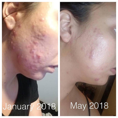 Organic Acne Fighter Oil Serum – Clear Skin Treatment