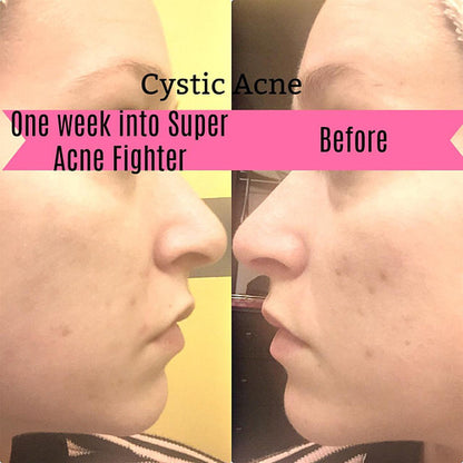 Organic Acne Fighter Oil Serum – Clear Skin Treatment